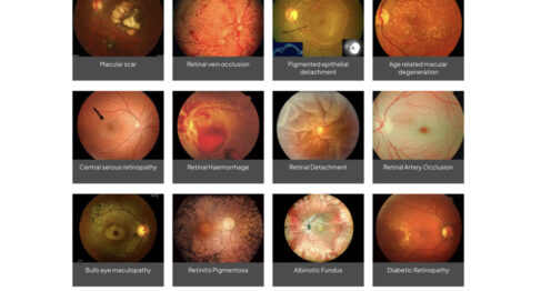 Dear Sir/Madam Microscope Camera & Video Recorder for slit lamp & eye surgery For attaching a camera and video recorder to a slit lamp or microscope used in eye surgery, here are some recommendations and considerations to ensure high-quality imaging and functionality: Key Features to Look for! Compatibility: Image and Video Quality: Sensor Sensitivity: Software Integration: Recording Capabilities: Live Streaming: Video editing: Recommended Products High-End Microscope Cameras Zeiss Series Leica Alcon Topcon Haag-Streit Appasamy Adapters and Accessories Beam splitter: C-Mount Adapters: Ring Light Adapters: Image Capture Software: Let me know if you need help selecting a specific brand or model for your setup!