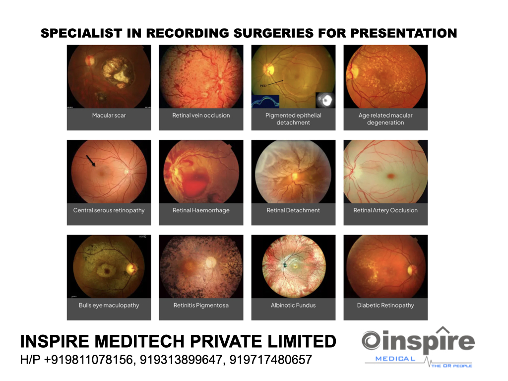 Dear Sir/Madam Microscope Camera & Video Recorder for slit lamp & eye surgery For attaching a camera and video recorder to a slit lamp or microscope used in eye surgery, here are some recommendations and considerations to ensure high-quality imaging and functionality: Key Features to Look for! Compatibility: Image and Video Quality: Sensor Sensitivity: Software Integration: Recording Capabilities: Live Streaming: Video editing: Recommended Products High-End Microscope Cameras Zeiss Series Leica Alcon Topcon Haag-Streit Appasamy Adapters and Accessories Beam splitter: C-Mount Adapters: Ring Light Adapters: Image Capture Software: Let me know if you need help selecting a specific brand or model for your setup!